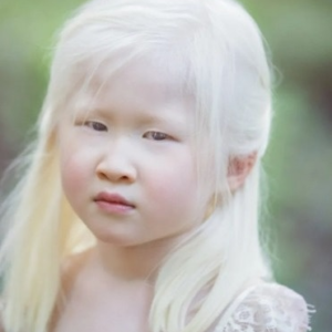 Girl Abandoned By Parents For Her Looks Wants To Prove The World Wrong